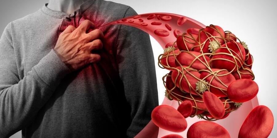 عادة بسيطة يوميًا قد تقلل خطر الجلطات.. ماذا يقول الأطباء؟