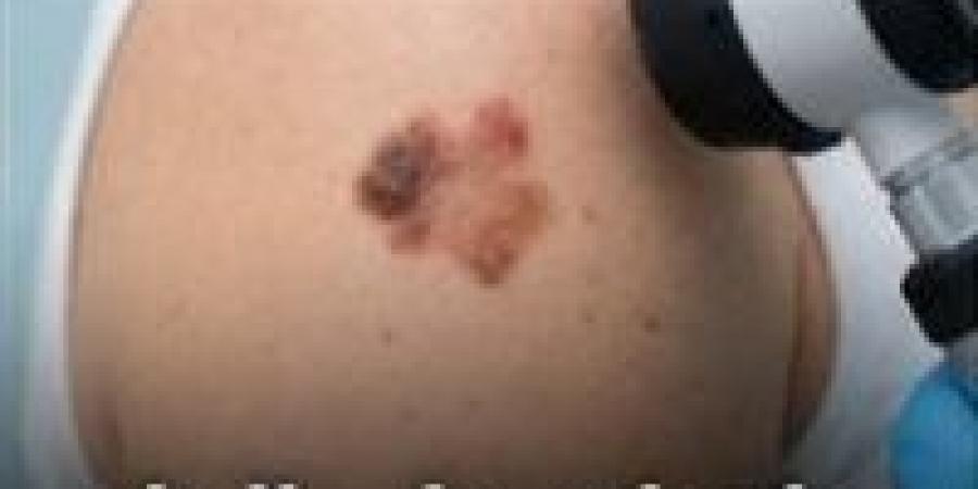 “إشارات علي جلدك ممكن تنقذ حياتك.. تجاهلها ممكن يكلفك كتير