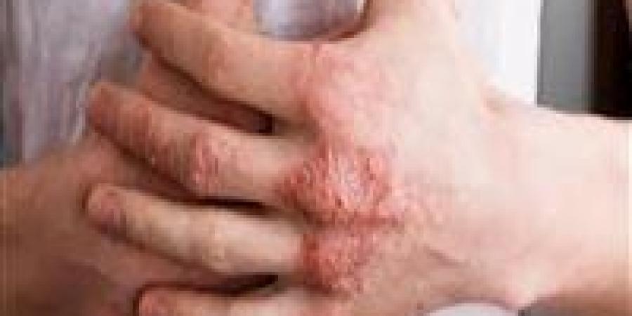 تعرف على أهم فوائد زيت جوز الهند لعلاج الإكزيما وطرق استخدامه الصحيحة