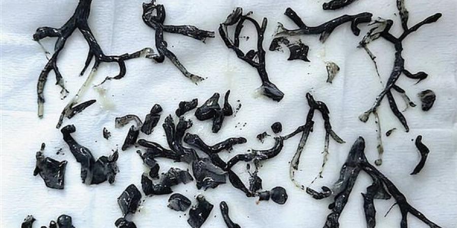 رجل يصاب بحالة نادرة بعد استنشاقه لدخان الحرائق (تفاصيل)