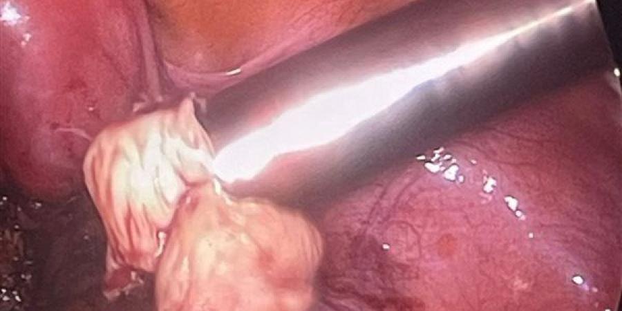 توسع في جراحات المناظير واستئصال الأورام الليفية بدقة عالية بمستشفى نبروه بالدقهلية