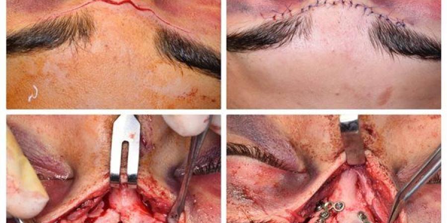 تدخل جراحي دقيق لإصلاح كسور بالوجه والجمجمة في مستشفى دكرنس بالدقهلية