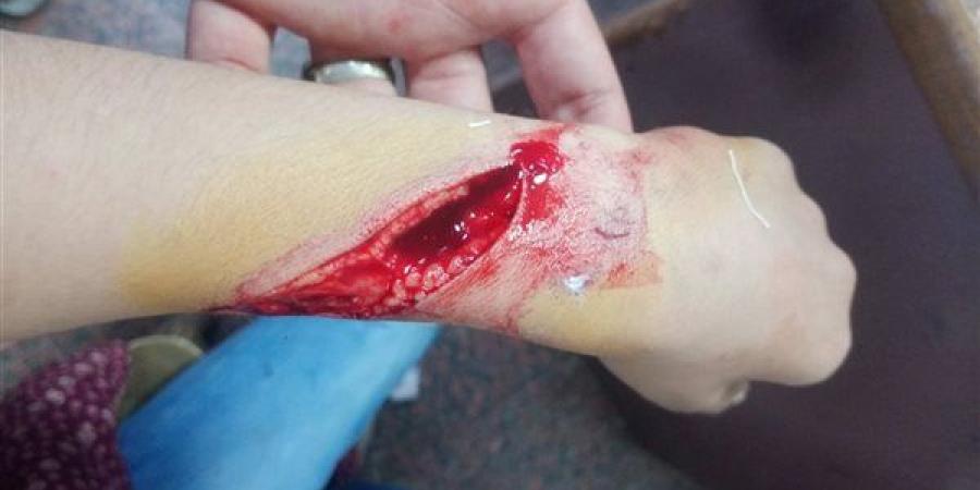 إصابة تلميذ بـ 18 غرزة بعد التعدي عليه بزجاجة أمام مدرسة بالفيوم