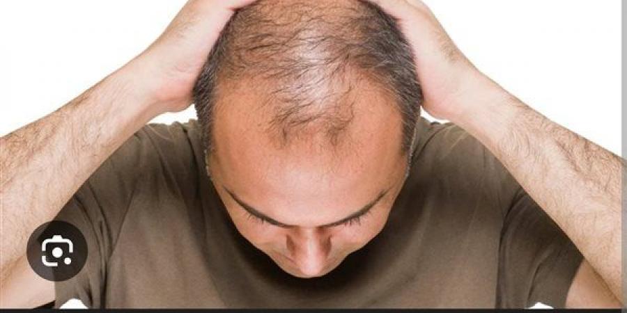 وصفات طبيعية لمواجهة الصلع.. حلول تقليدية بفعالية متجددة