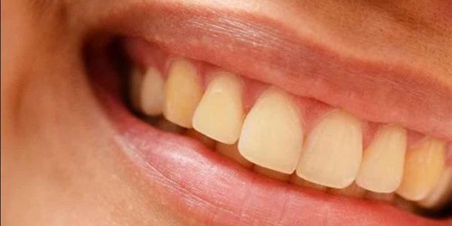 أطعمة مفيدة وأخرى ضارة للأسنان