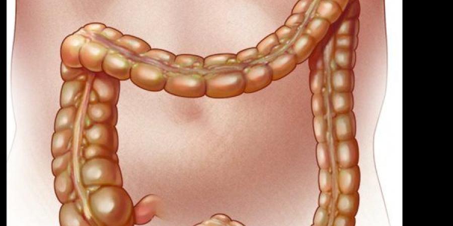 التهاب الزائدة الدودية.. أعراض تبدأ بألم بسيط وقد تنتهي بمضاعفات خطيرة