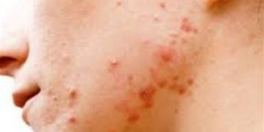 وصفات طبيعية فعّالة لعلاج حبوب الشباب وحساسية الجلد