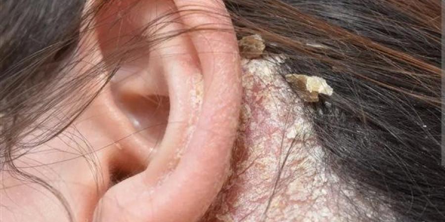 فطريات الشعر.. طرق العلاج وأبرز وسائل الوقاية للحفاظ على فروة رأس صحية