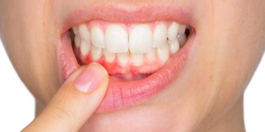 نزيف اللثة ليس طبيعيًا دائمًا.. علامات قد تشير إلى التهابها