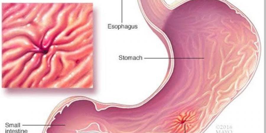 أفضل الأطعمة والمشروبات لعلاج قرحة المعدة ودعم صحة الجهاز الهضمي
