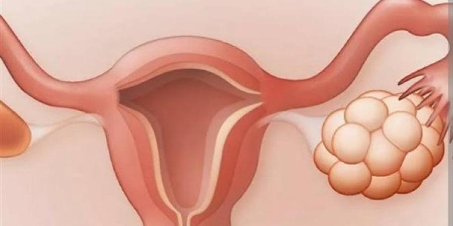 علاج فعال لتكيس المبياض