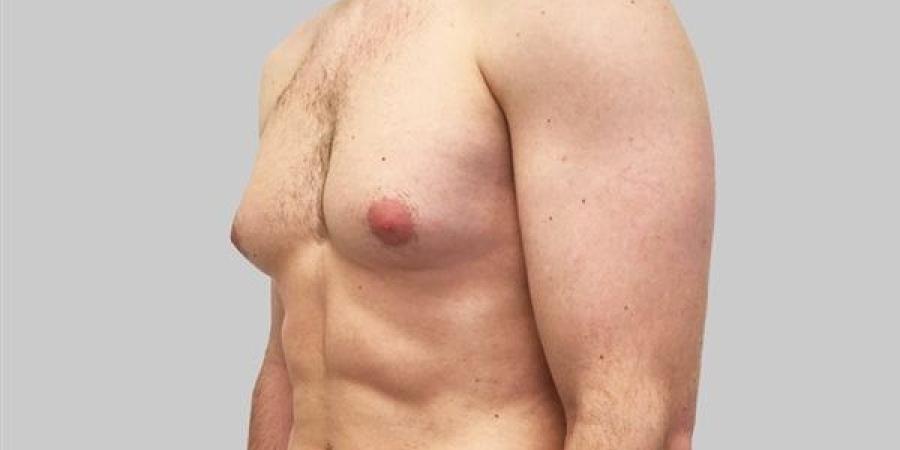 تثدي الرجل يزيد خطر الإصابة بالسرطان 3-5 مرات