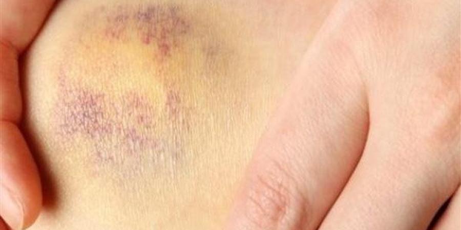 الكدمات المفاجئة قد تكون أحد أعراض مرض خطير