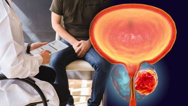 تأثير تضخم البروستاتا على القدرة على الإنجاب توضيح من استشاري مسالك الفم