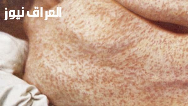 مرض يهدد ولاية بنسلفانيا الأمريكية ب460 حالة حالياً